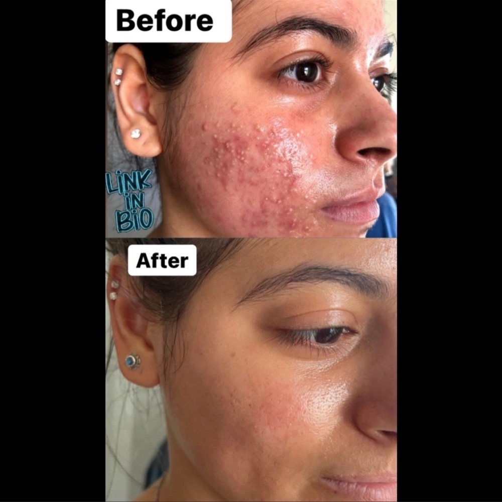 TREE’O Acne Skincare Bundle Sale limited time only